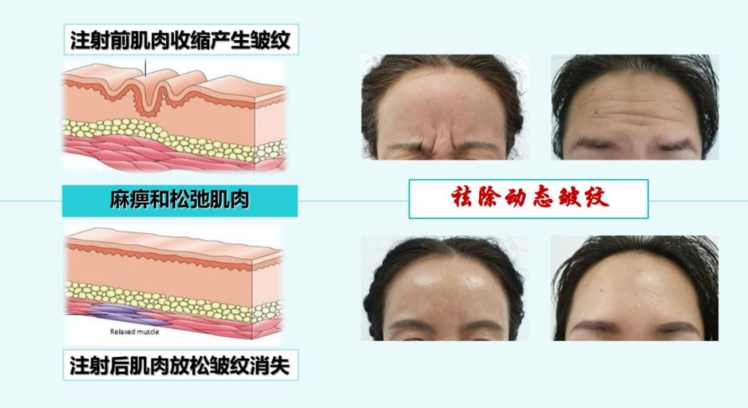 医者名片| 想打美容针？十条肉毒素“大起底”你不可不看！-第2张图片-ZBLOG